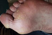 Is dit Pitted Keratolysis of niet?