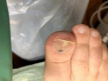 Is hier sprake van een schimmelnagel?