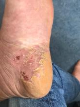 Hoe behandel ik psoriasis palmoplantaris