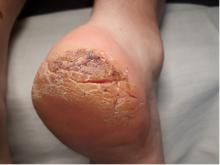 Hoe kan ik diepe kloven/ragaden behandelen-1