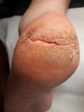 Hoe kan ik diepe kloven/ragaden behandelen- 2