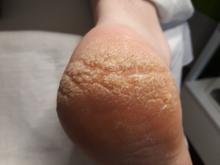 Hoe kan ik diepe kloven/ragaden behandelen- 3