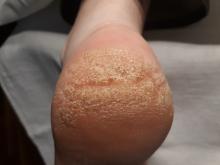 Hoe kan ik diepe kloven/ragaden behandelen- 4