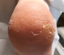 Hoe kan ik diepe kloven/ragaden behandelen- 5