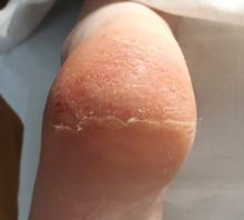 Hoe kan ik diepe kloven/ragaden behandelen- 6