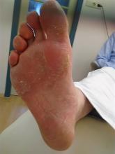 Heeft mijn client wellicht mycose of eczeem?