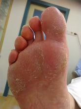 Heeft mijn client wellicht mycose of eczeem? 1