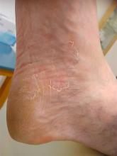 Heeft mijn client wellicht mycose of eczeem? 2