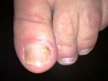 Schimmel of ontsteking