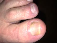 Schimmel of ontsteking2