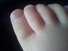 Wat is de oorzaak van deze bladderende nagel bij een peuter