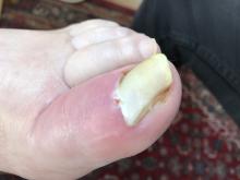 Wat is er met deze nagel aan de hand?