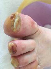 Wat is het advies bij deze lokale hyperkeratose en groeiproblemen nagel hallux