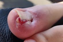 Wat kan ik als pedicure doen met zo’n ernstige ingroeiende nagel