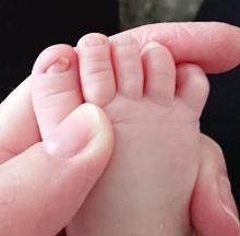 Wat te doen bij een ingroeiende nagel bij een baby
