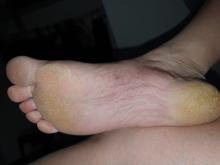 Wat te doen bij hyperkeratose met putjes en harde plekjes?