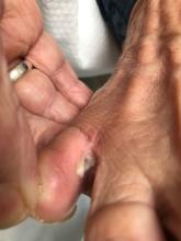 Hoe behandel ik deze interdigitale clavus?