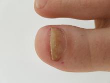 waarom herstelt deze nagel niet